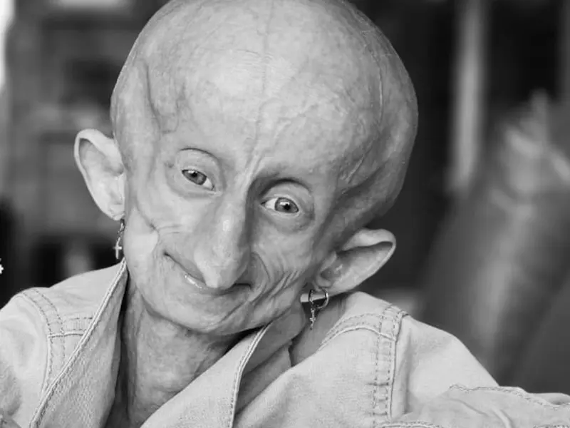 Beandri Booysen, joven sudafricana y estrella de TikTok, fallece a los 19 años tras enfrentar el síndrome de Progeria.