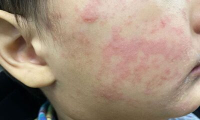 En total suman 4 mil 849 personas contagiadas; los menores de edad de 0 a 4 años son el grupo más afectado con mil 210, y desde los 25 hasta los 34 años suman mil 110.