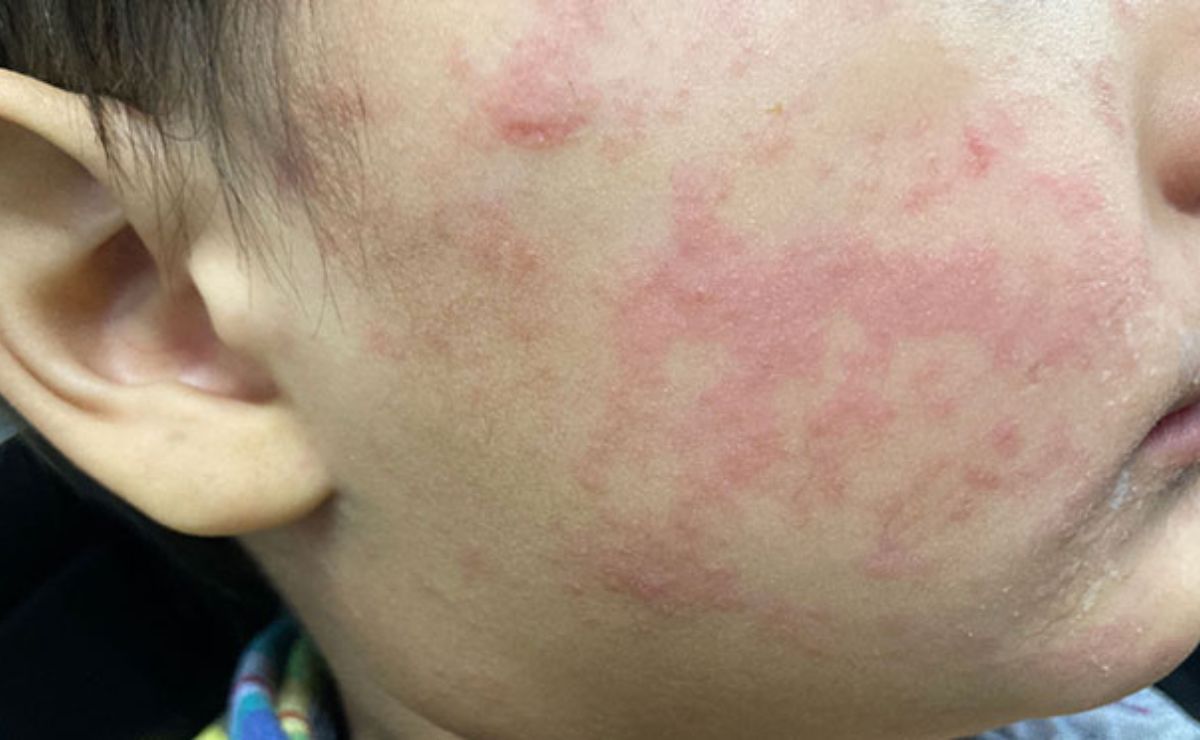 En total suman 4 mil 849 personas contagiadas; los menores de edad de 0 a 4 años son el grupo más afectado con mil 210, y desde los 25 hasta los 34 años suman mil 110.