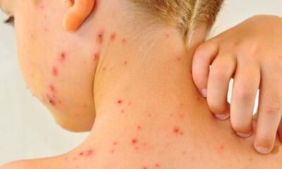 Los pacientes son ocho mujeres y cinco hombres, de entre 5 meses y 34 años, ninguno con esquema completo de vacunación. Permanecen en aislamiento domiciliario con evolución estable.