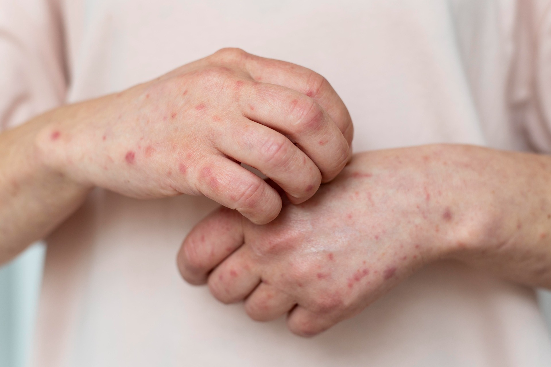 Los contagios se distribuyen en 29 entidades del país, siendo Chihuahua el estado más afectado con cuatro mil 465 casos, seguido de Jalisco con 414, Guerrero con 225, Michoacán con 208 y Sonora con 102.