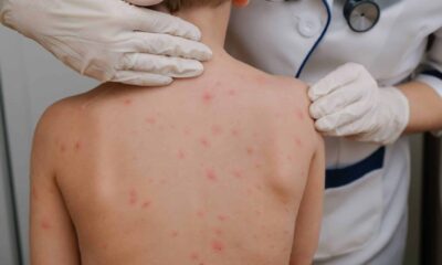 La Secretaría de Salud reiteró la importancia de la vacunación como principal medida de prevención.