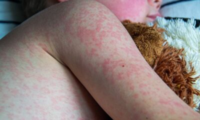 Ante este panorama, la Secretaría de Salud de Nuevo León mantiene activa la jornada de vacunación contra el sarampión