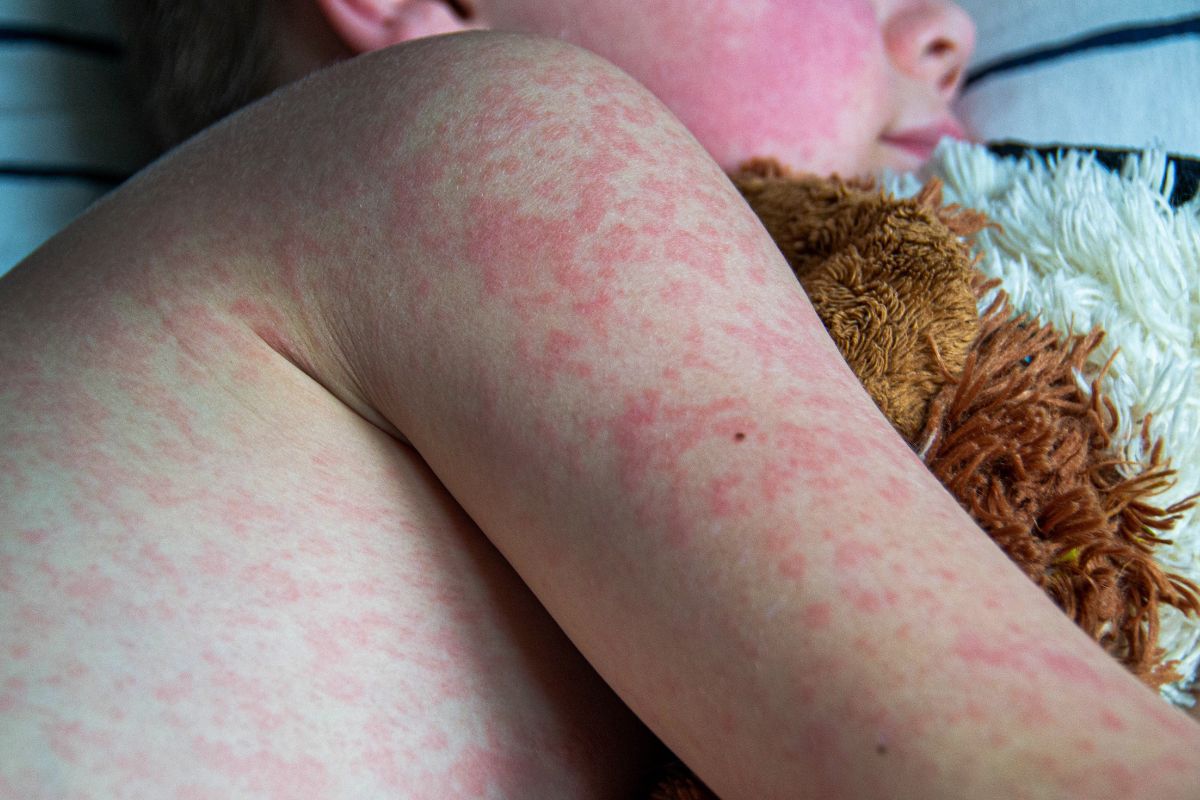 Ante este panorama, la Secretaría de Salud de Nuevo León mantiene activa la jornada de vacunación contra el sarampión