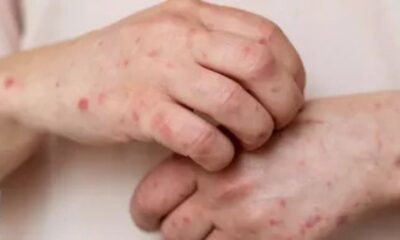 A nivel nacional, con corte al 3 de febrero, se han confirmado mil 858 casos de sarampión durante 2026