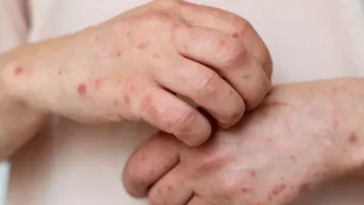 A nivel nacional, con corte al 3 de febrero, se han confirmado mil 858 casos de sarampión durante 2026