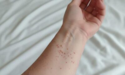 Las muertes de este año se han registrado en Jalisco, Durango, Michoacán y Tlaxcala, y en todo el país se acumulan 3 mil 643 casos confirmados de esta enfermedad.