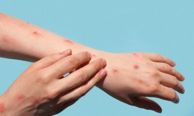 Las autoridades detallaron que 6,444 contagios corresponden a 2025 y 4,618 a lo que va de 2026.