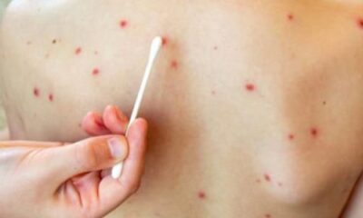 En 2025 se confirmaron 14 mil 891 casos de sarampión de los cuales México encabezó la lista con más de seis mil contagios.