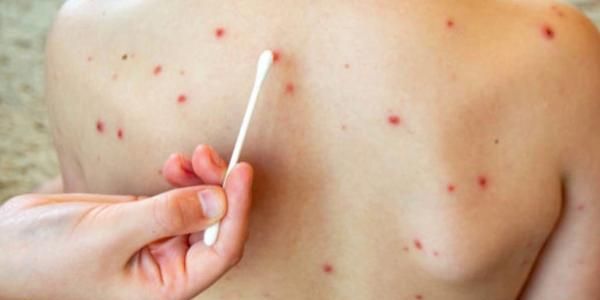 En 2025 se confirmaron 14 mil 891 casos de sarampión de los cuales México encabezó la lista con más de seis mil contagios.