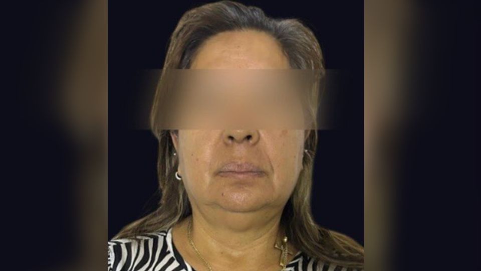 La intervención habría sido realizada sin las condiciones médicas necesarias, lo que provocó un deterioro grave en la salud de la paciente. Debido a las complicaciones, médicos tuvieron que amputarle la pierna izquierda para preservar su vida.